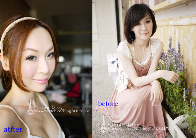 V妞隆乳before-after