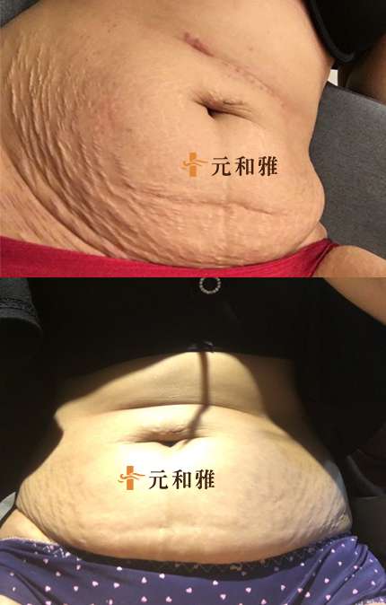多層次筋膜腹部拉皮手術,腹部拉皮