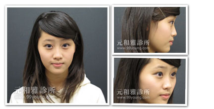 卡麥拉隆鼻讓你遇見更好的自己~台灣卡麥拉隆鼻口碑推薦評價案例照片